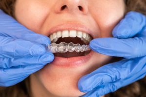 Invisalign Shrewsbury