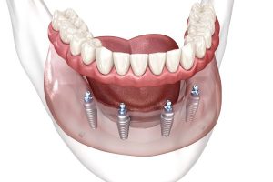 dental Implant Leeds