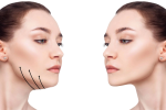 Double Chin Removal Non-Invasive Treatments That Deliver Results