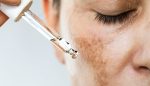 Hyperpigmentation facial treatment