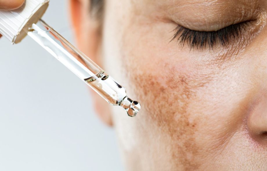Hyperpigmentation facial treatment