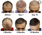 best hair transplant in Ahmedabad