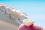 dental crowns chippewa falls