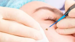 wart removal