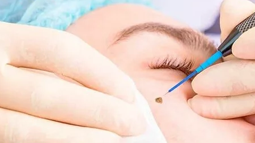 wart removal